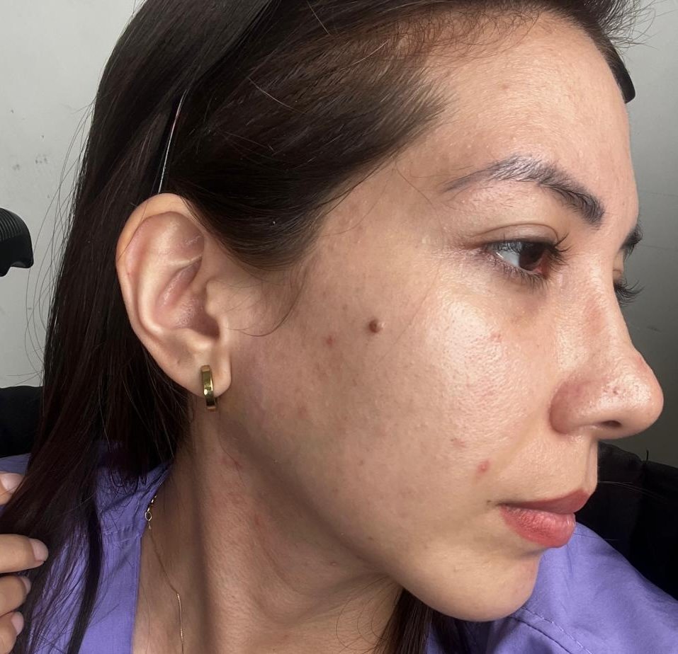 Después del tratamiento Lumicen ADN de Salmón - rejuvenecimiento facial en Oasis Bolivia